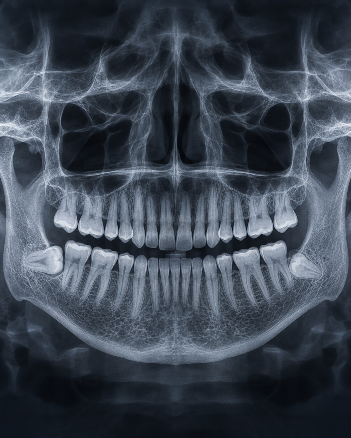 Panoramic CBCT radiograph of the jaws showing an impacted third molar